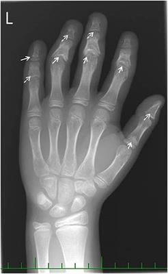 Tubuloglomerular Disease With Cone-Shaped Epiphyses Associated With Hypomorphic Variant and a Novel p.Cys14Arg in the TTC21B Gene: A Case Report